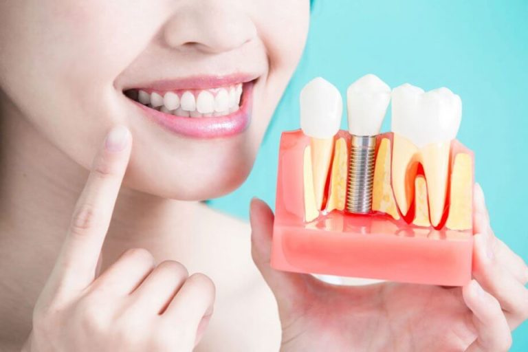 dentalimplants-800-Oct2018-920x613