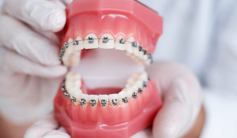 traditional-metal-braces-1170x684